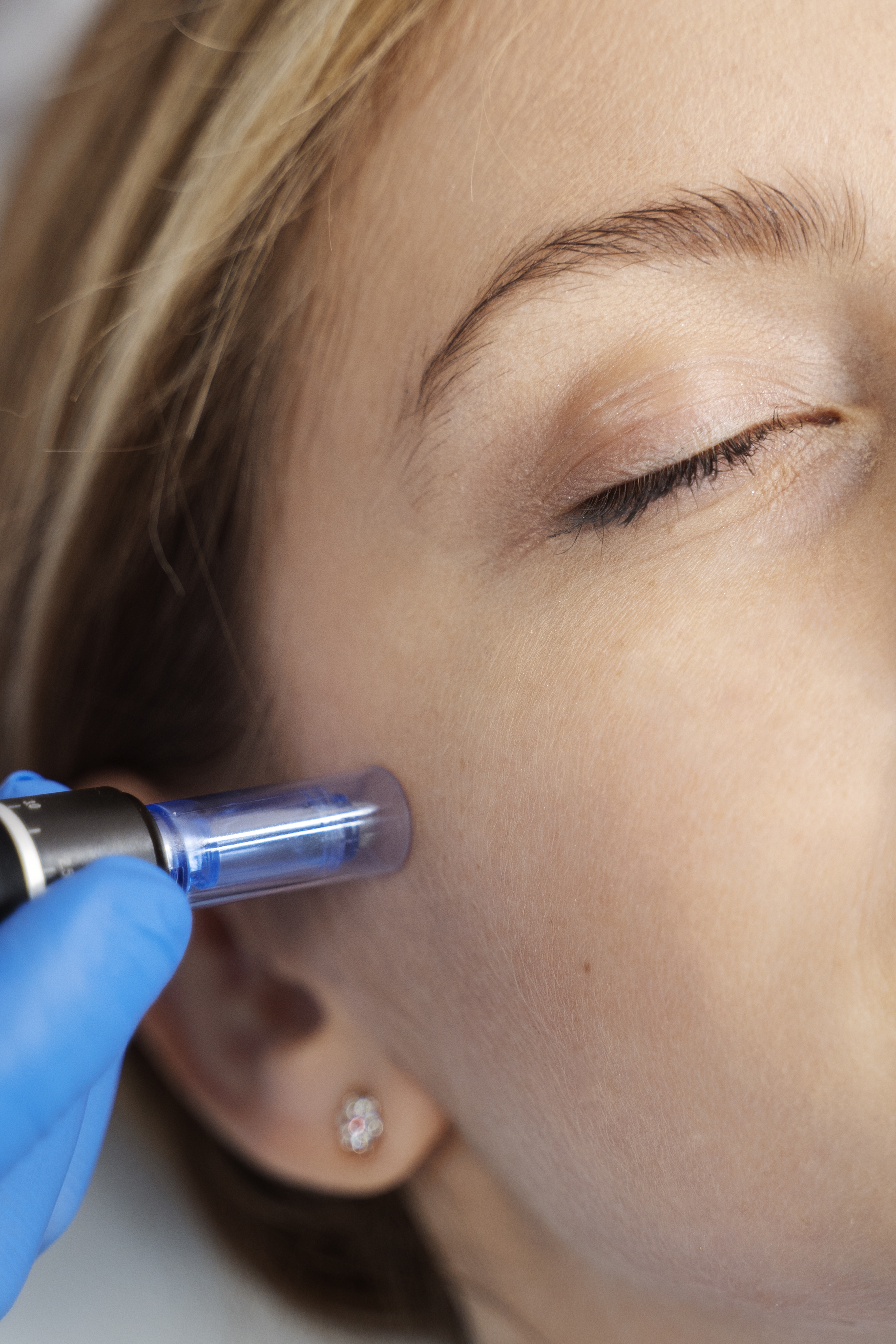 Microneedling-Behandlung im Gesicht mit Pen